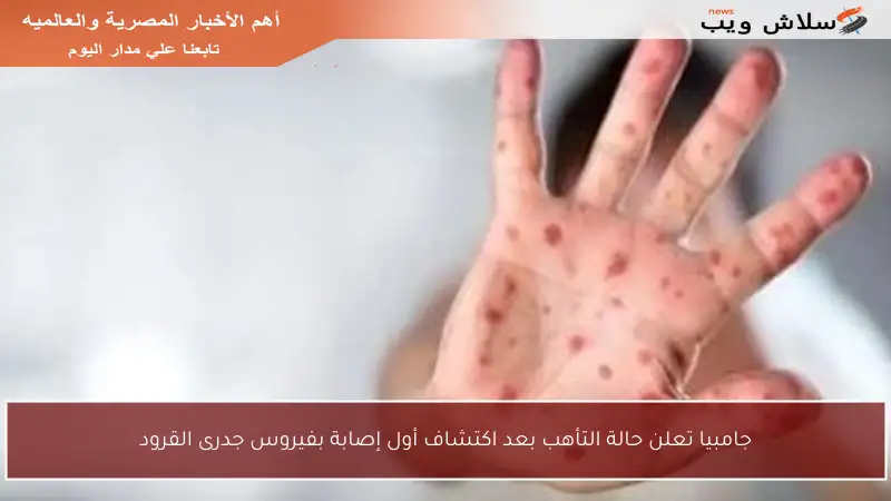 جامبيا تعلن حالة التأهب بعد اكتشاف أول إصابة بفيروس جدرى القرود