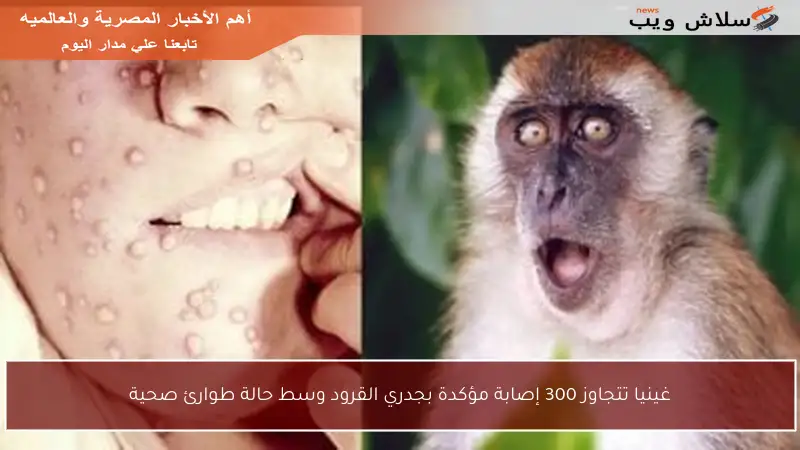 غينيا تتجاوز 300 إصابة مؤكدة بجدري القرود وسط حالة طوارئ صحية